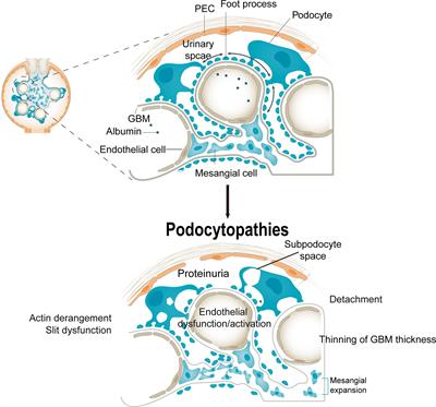 Epigenetics and endoplasmic reticulum in podocytopathy during diabetic nephropathy progression